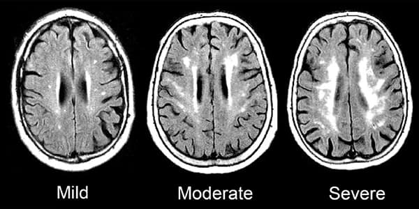 stages of brain inflammation