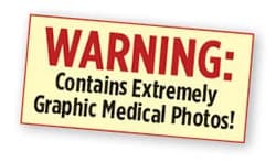 WARNING: Contains Extremely Graphic Medical Photos!