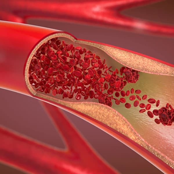Arteriosclerosis