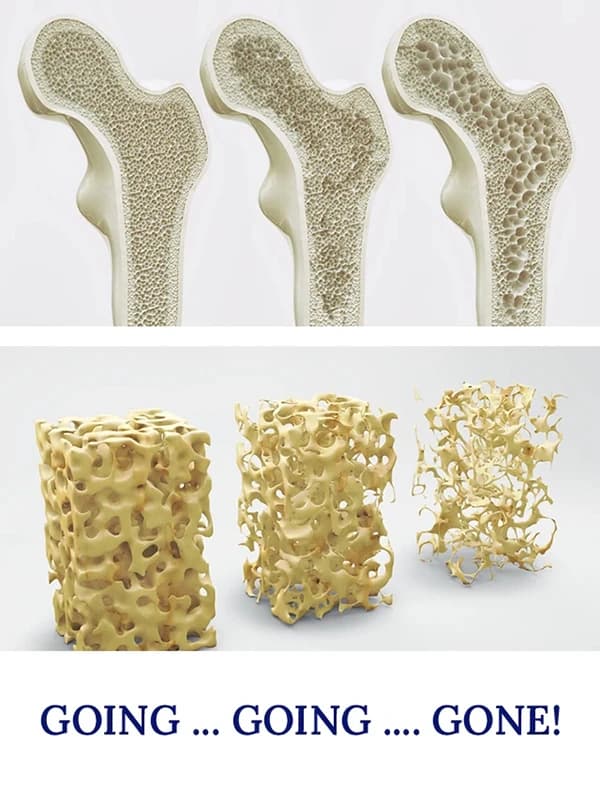 Osteoporosis