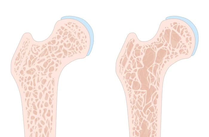 Osteoporosis