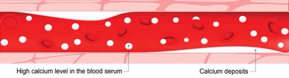 Calcium buildup in arteries