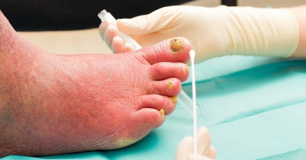 The Growing Threat of Fungal Infections about false